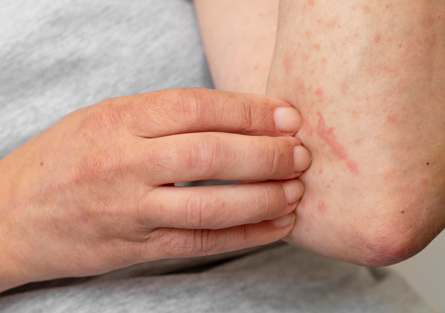 Erupciones cutáneas